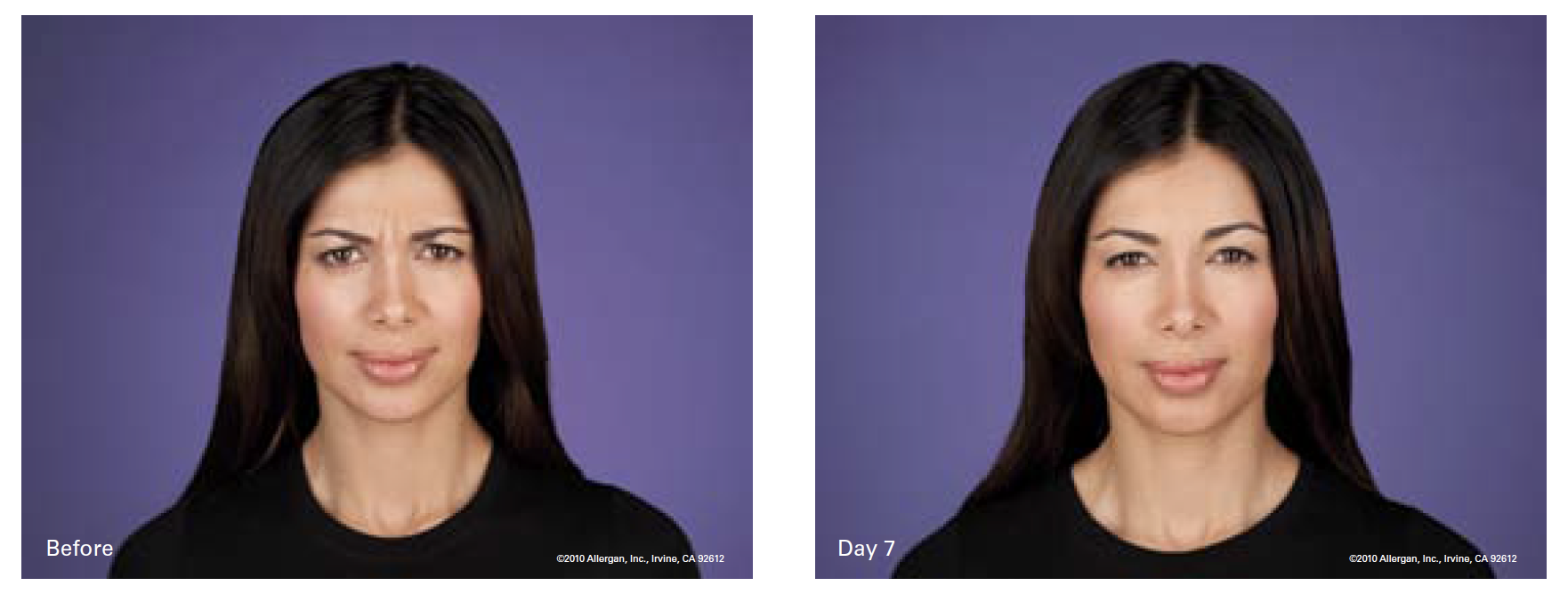 Female Patient Before and After Botox