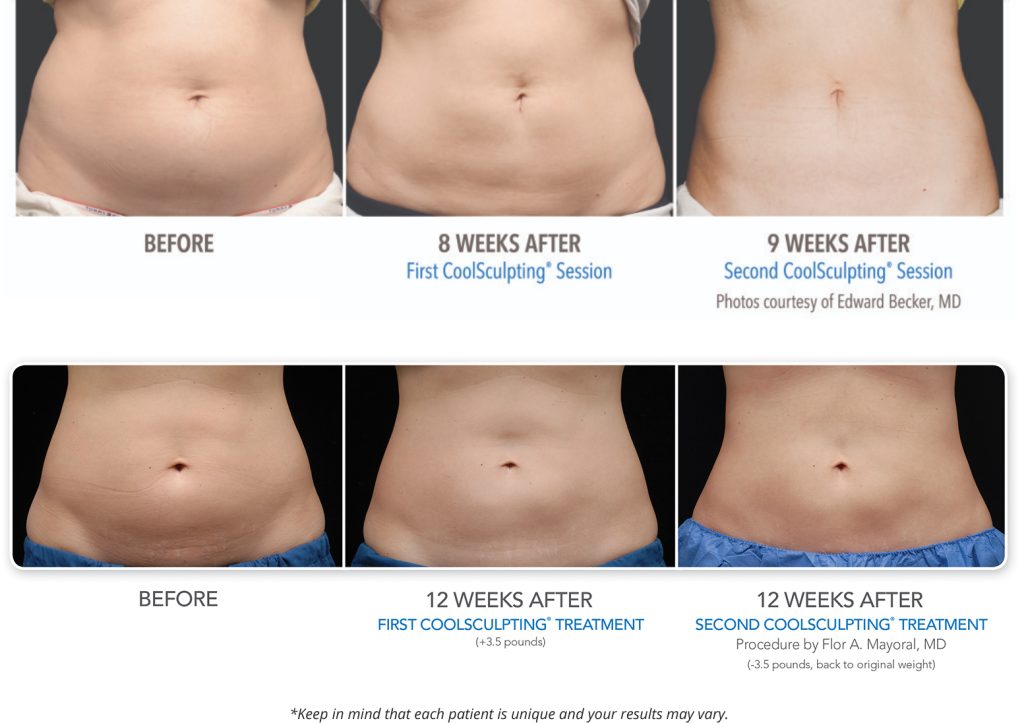 How To Get the Best CoolSculpting® Results in Barrington, IL