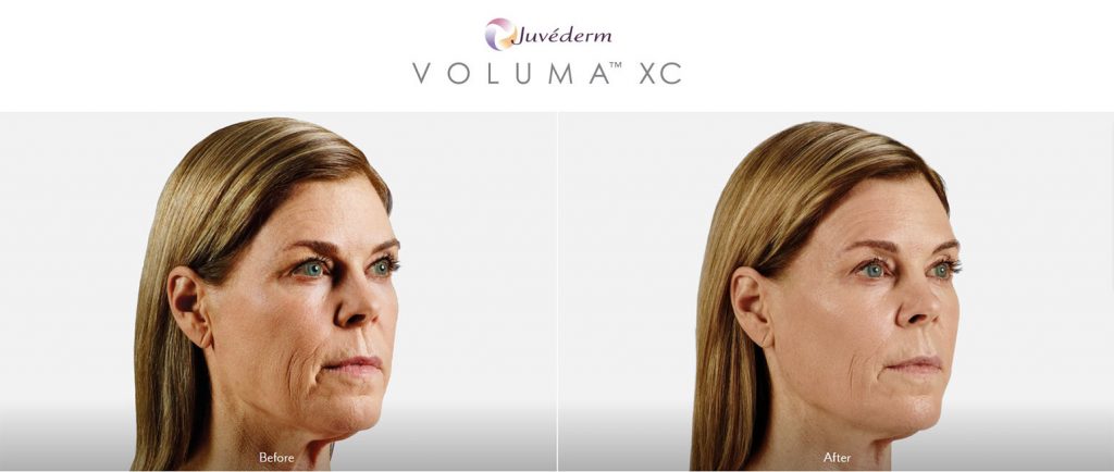Juvederm Voluma Patient Before and After Treatment Female
