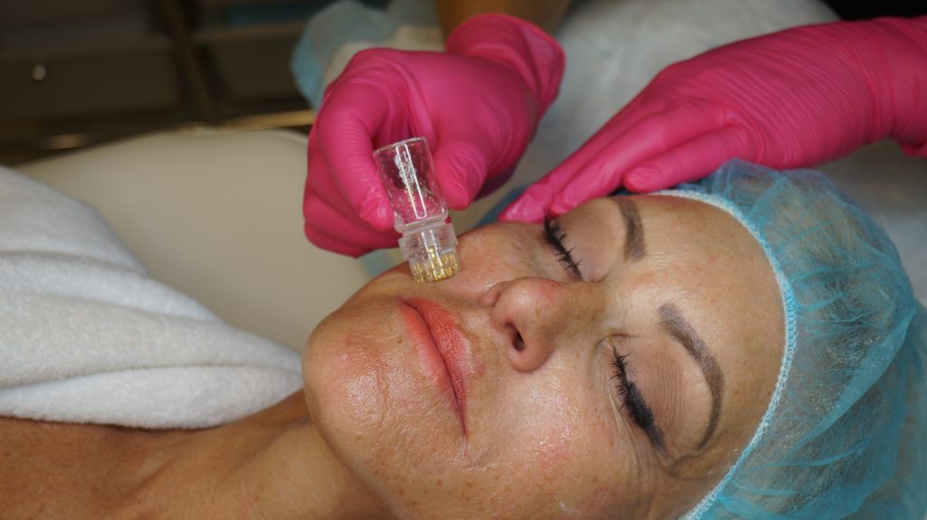 Woman receiving AquaGold treatment