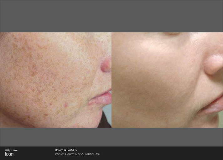 Face Blemishes Before and After Light Treatment