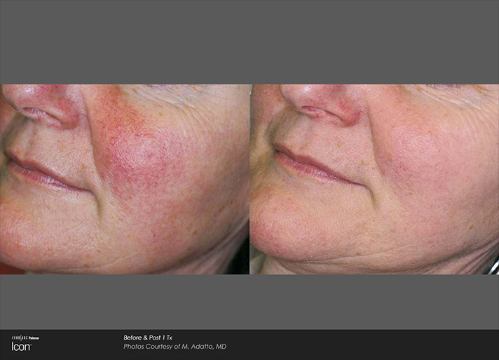 Cheek Redness Before and After Light Treatment