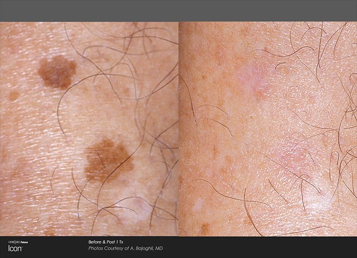 Skin Spots Before and After Light Treatment