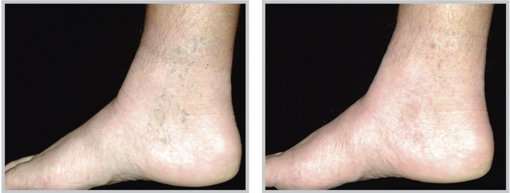 before and after vascular laser treatment on foot