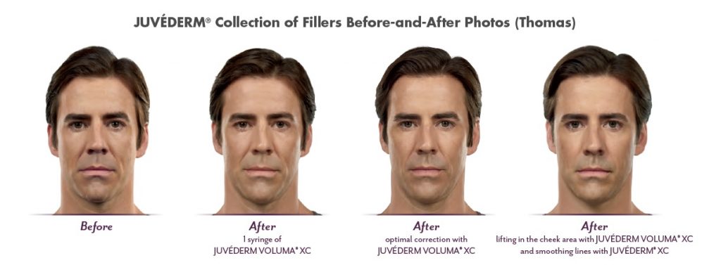 before and after juvederm treatments on male