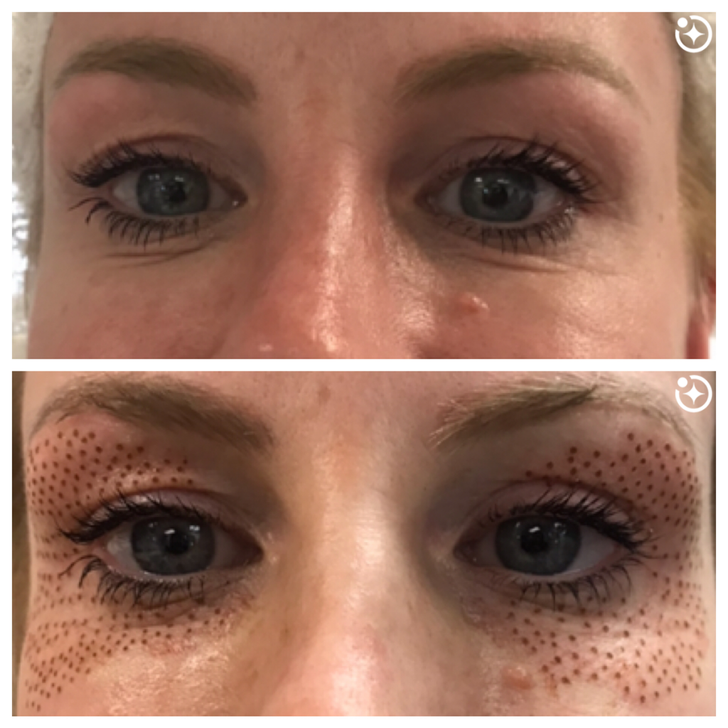 Plasma Pen - before and after upper and lower eyelids