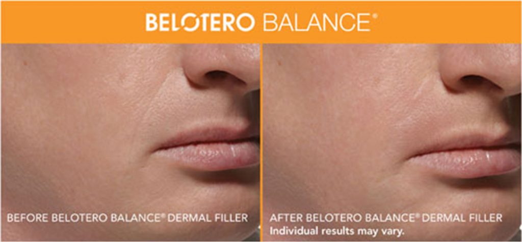 before and after belotero results on male