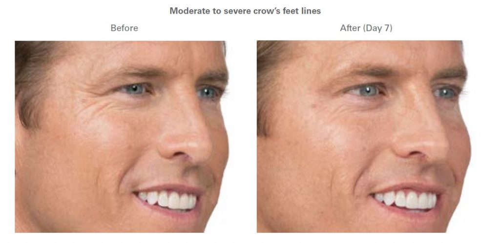 before and after botox results on male