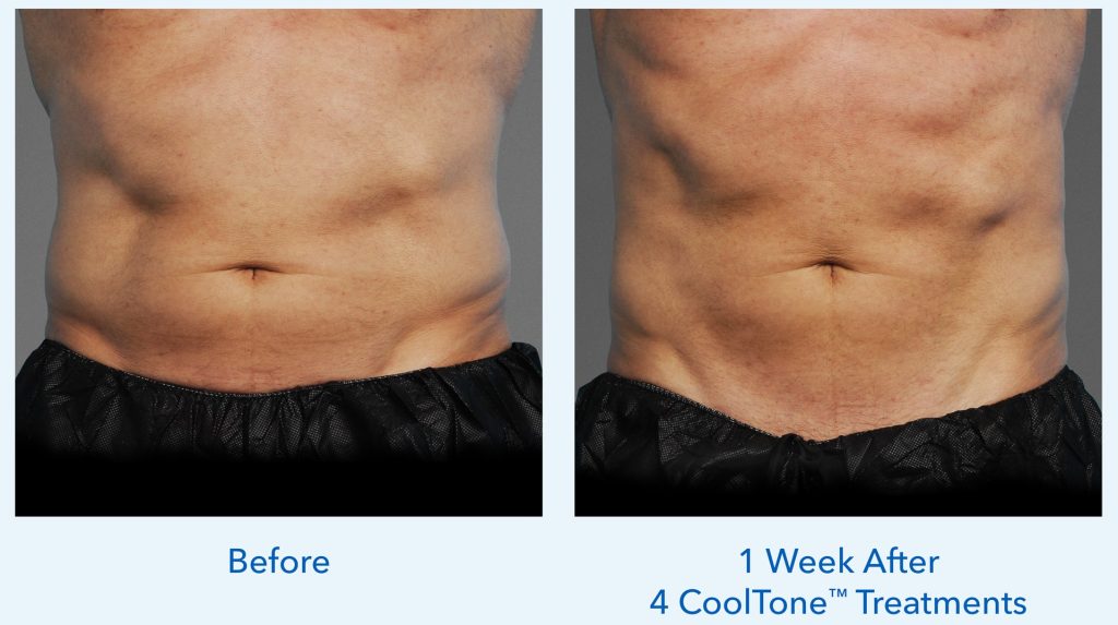 before and after cooltone results on males stomach
