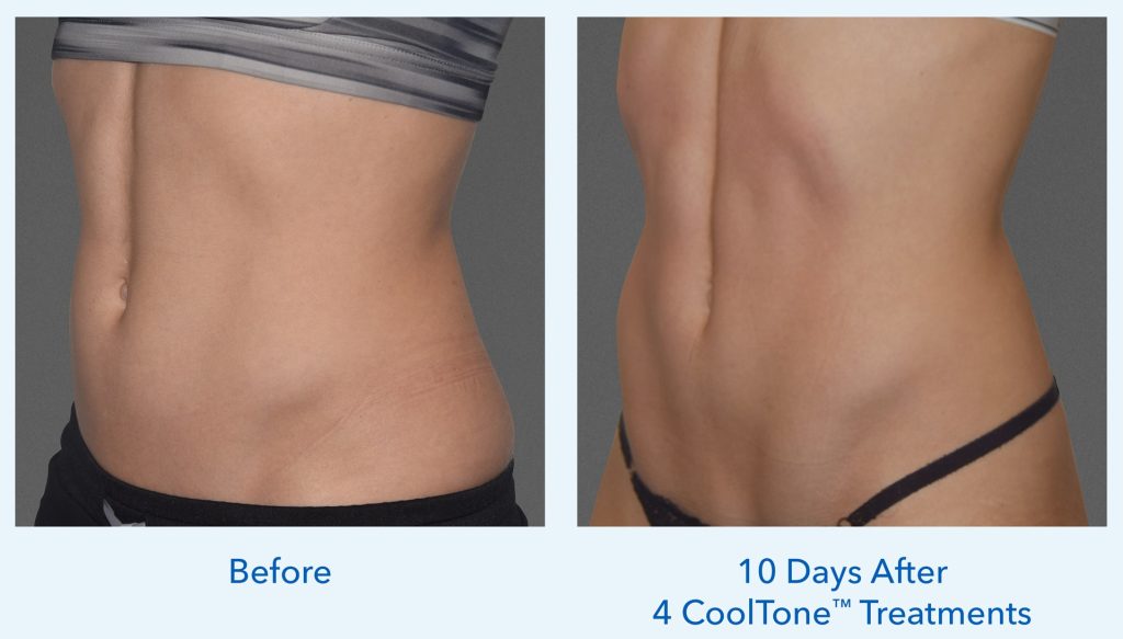 before and after cooltone results on womans stomach