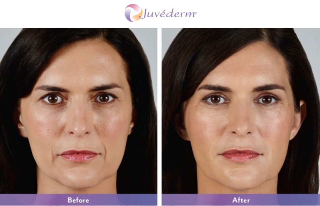 before and after juvederm results on woman
