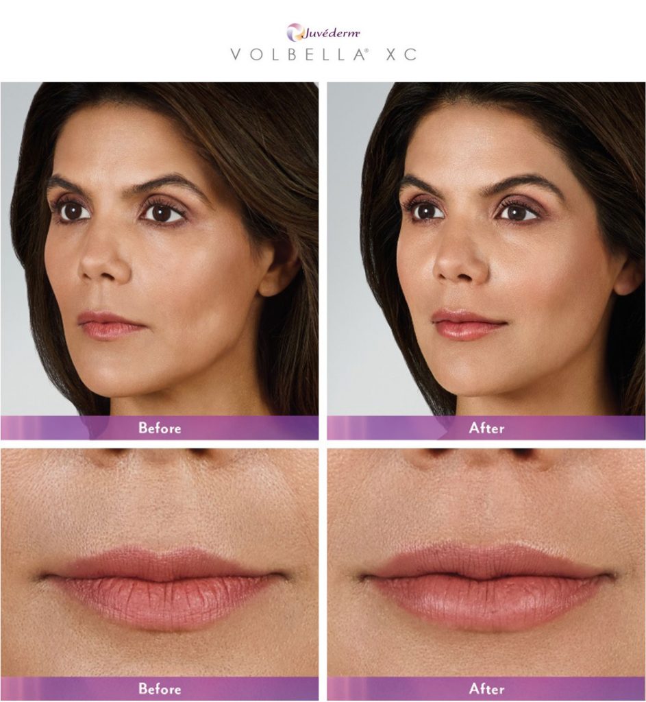 before and after juvederm volbella results on woman