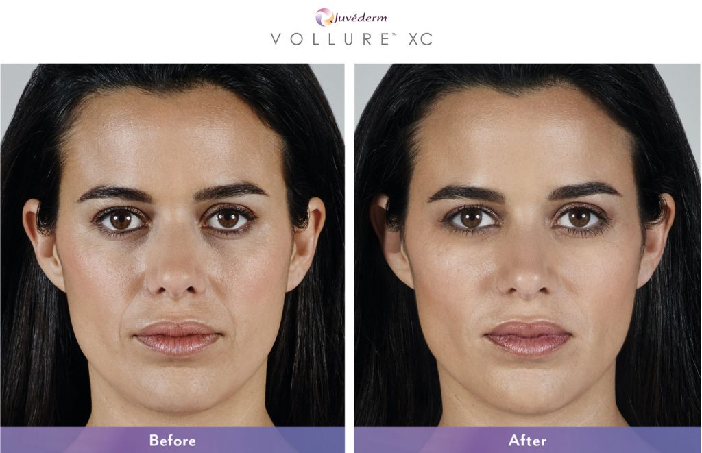 before and after vollure results on woman