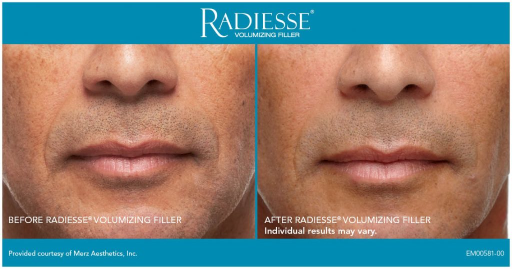 before and after radiesse results on male