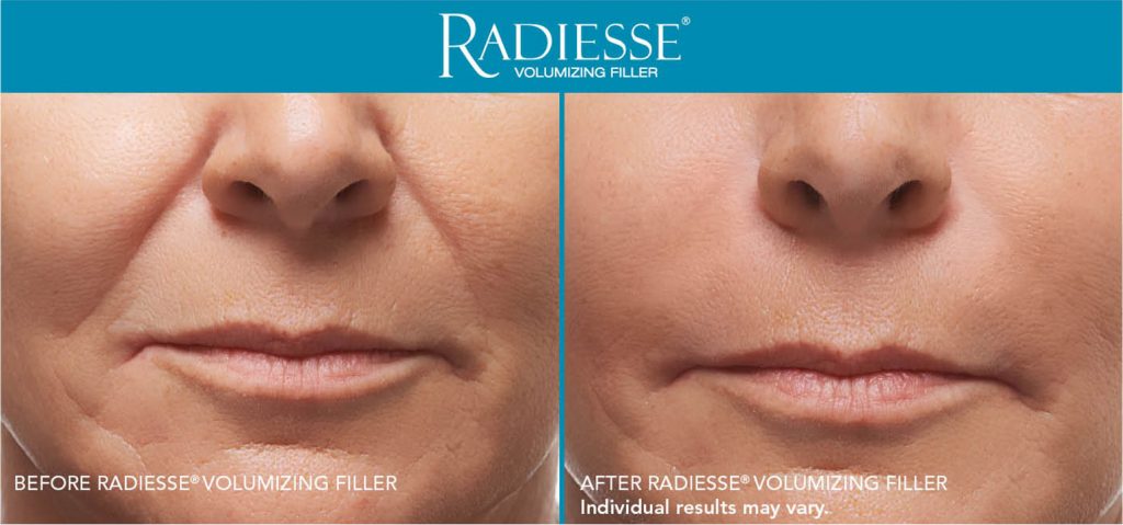 womans lips before and after radiesse