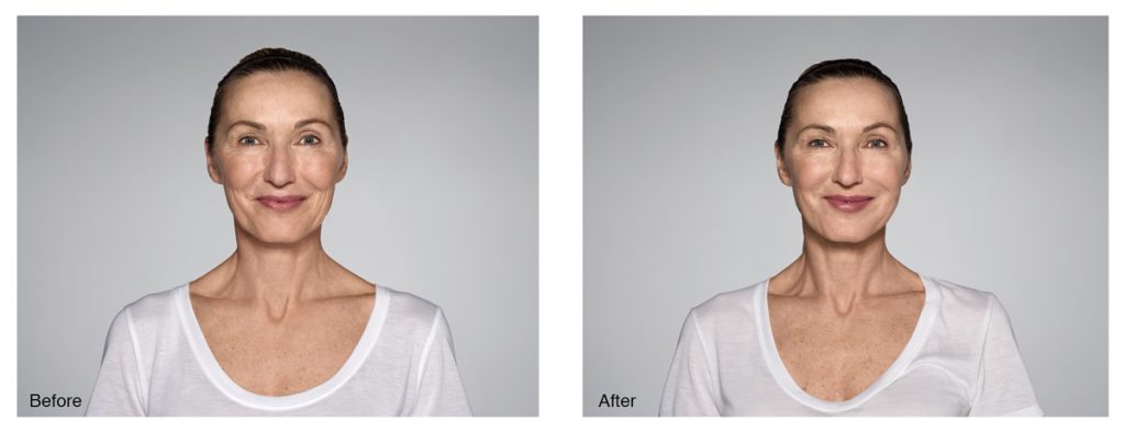 before and after restylane results on woman
