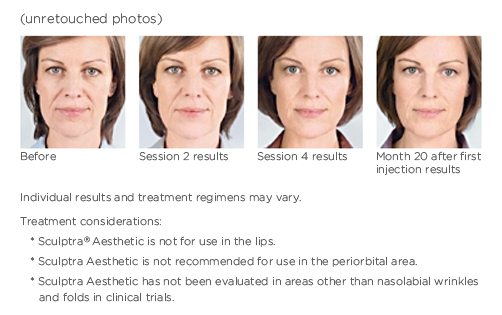 before and after sculptra aesthetic treatments on woman
