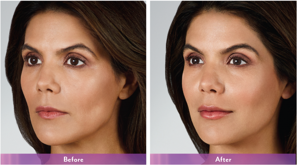 before and after volbella results on woman