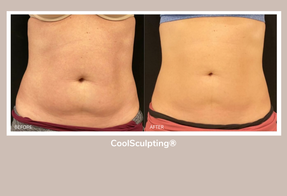 How To Get the Best CoolSculpting® Results in Barrington, IL, Renee Burke,  MD