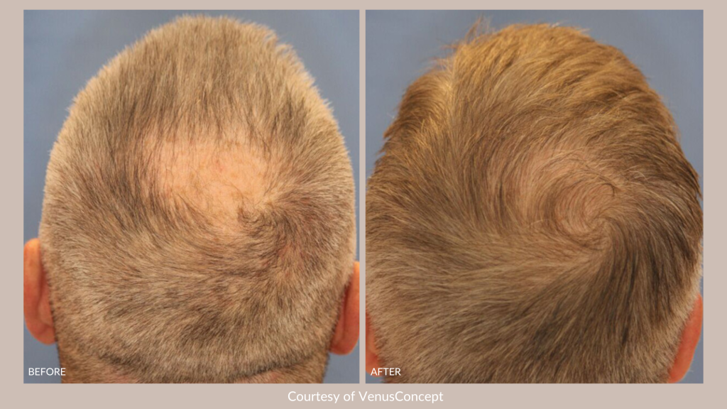 NeoGraft® Before and After Image